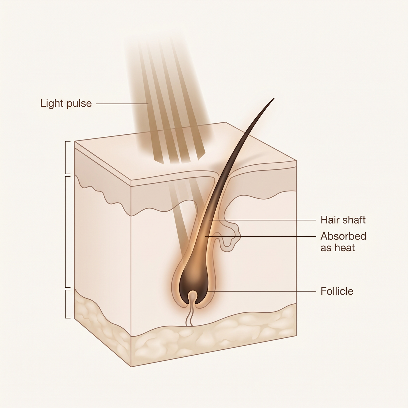 Diagram of IPL light reaching the hair follicle